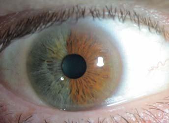 Diagnosis: Iris Nevus Common iris tumor