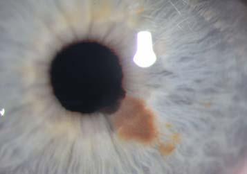 mm (average is 2mm), distortion of iris
