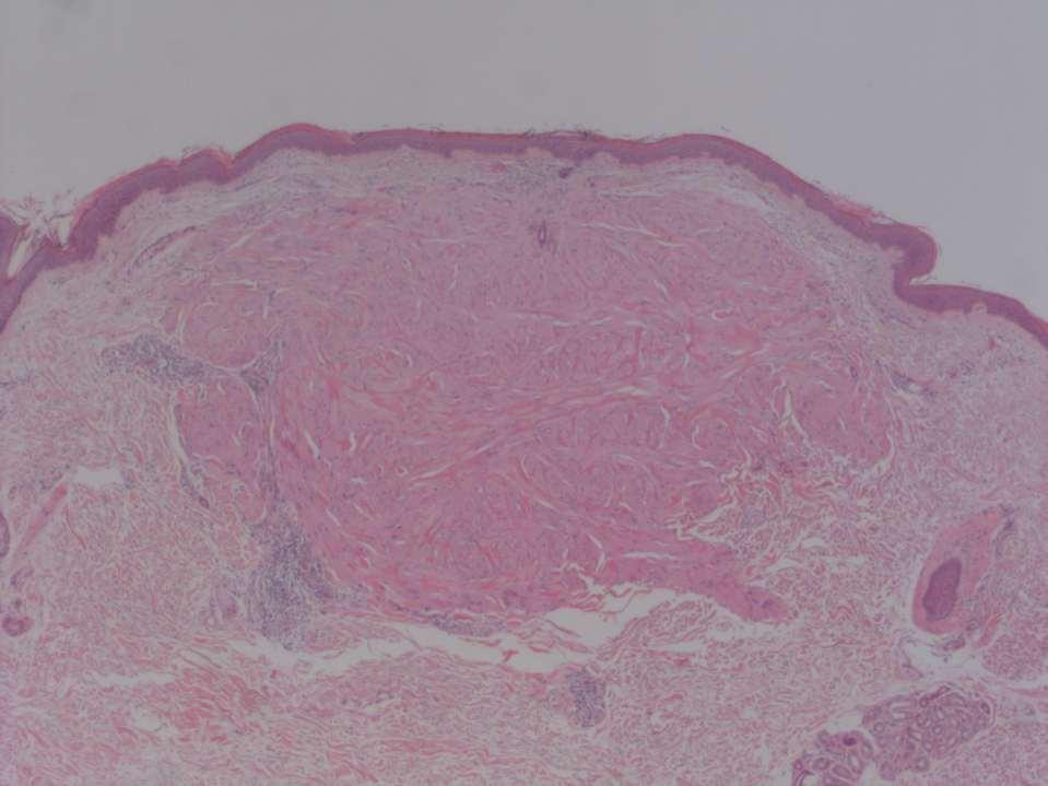 Pilar Leiomyoma Histology Confined to dermis Irregular border, not encapsulated Bundles of mature smooth