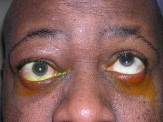 eyelid retraction or Von Graefes Eye Symptoms