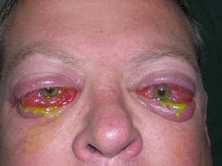 Spectrum of Thyroid Eye Disease Mild in most,
