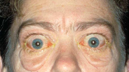 Ophthalmic surgery Indications for