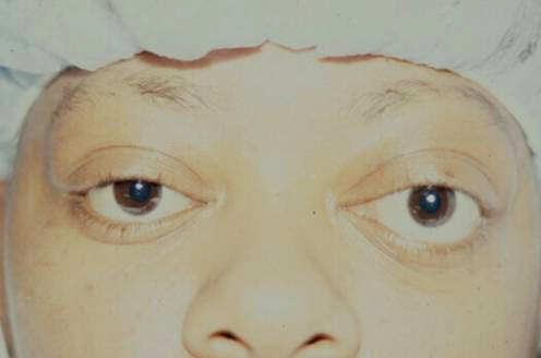 surgery Eyelid