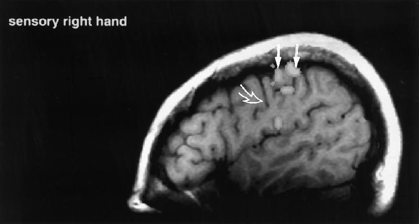 The activation in the sensorimotor cortex (vertical arrows in B) corresponds with the central sulcus (open arrow in A) selected on the basis of anatomic landmarks.