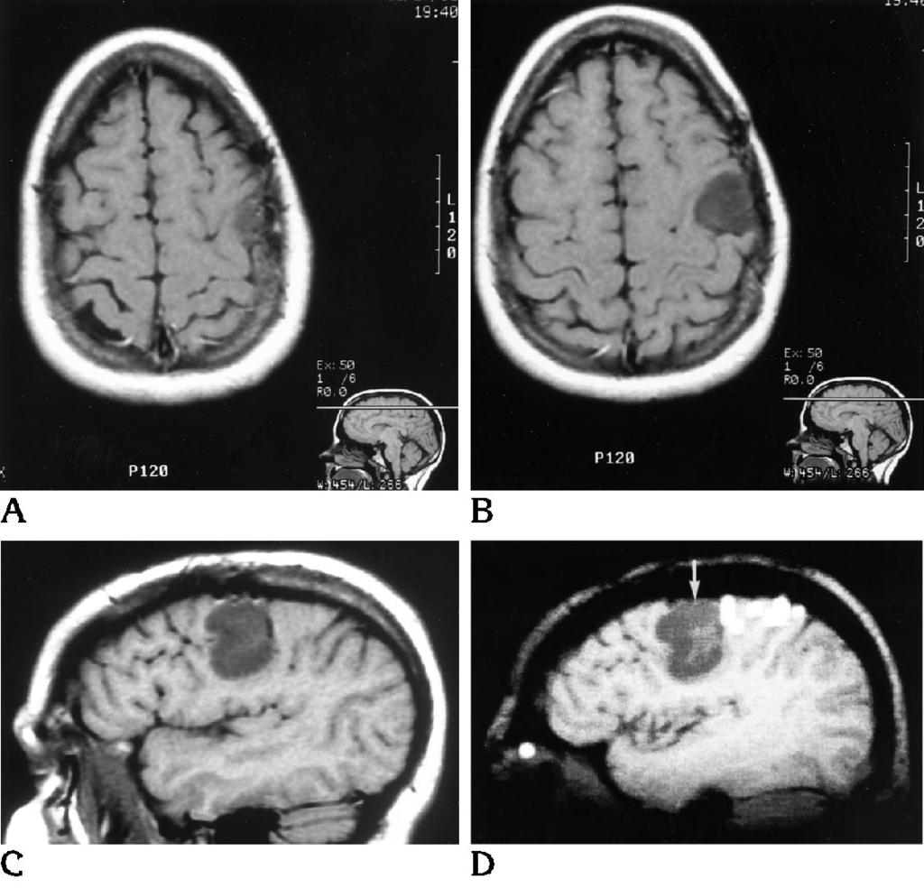 2112 YETKIN AJNR: 16, November 1995 Fig 3. Axial (A and B) and parasagittal (C) images in a patient with a frontal lobe tumor.