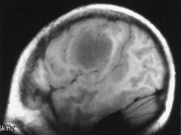 Sagittal MR image in another frontal lobe tumor. The central sulcus was not identified in sagittal or axial images. Activation was identified ventral to this tumor. and postcentral gyri.