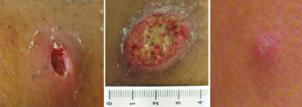 Dantas ML et al - CD8+ T cells and cytotoxicity in CL A B C FIGURE 1 - Typical lesions caused by different clinical forms of cutaneous leishmaniasis. A: Early cutaneous leishmaniasis lesion.