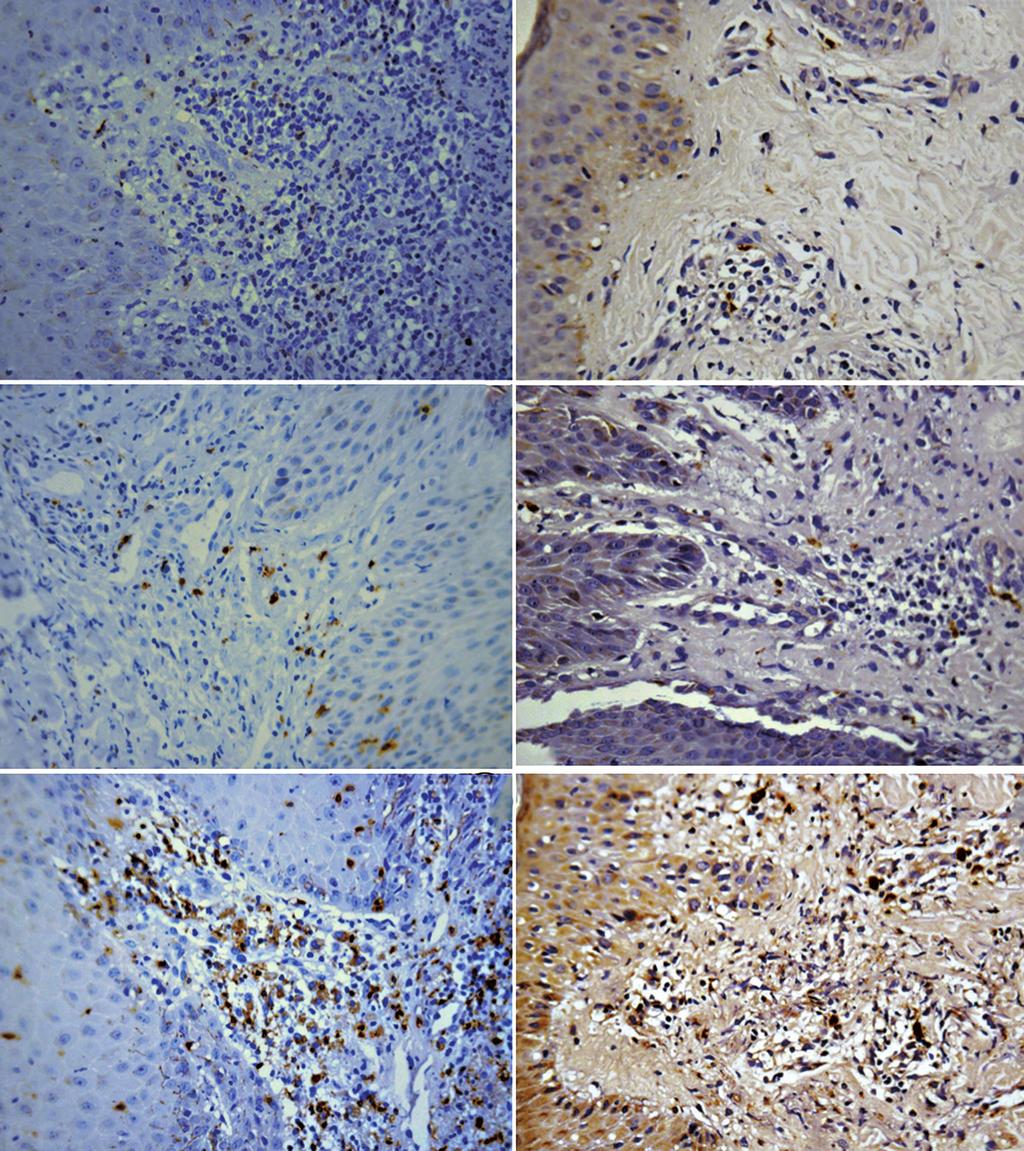 Rev Soc Bras Med Trop 46(6):728-734, Nov-Dec, 213 TABLE 2 - Number of cases with a high frequency of immunostained cells in the papillary dermis or reticular dermis.