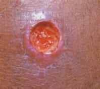 major Causes a moist, cutaneous, ulcerlike lesion