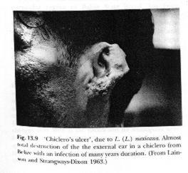 However, when the bite occurs on the ear it results in chronic lesions known as chiclero's