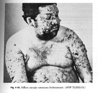 Diffuse Cutaneous Leishmaniasis In some patients, especially in Venezuela, a diffuse cutaneous