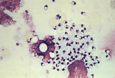Diagnosis of Cutaneous Leishmaniasis Microscopic detection of amastigotes (LD bodies) in stained