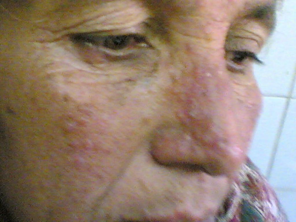 but treatment was not stopped prematurely in any patient. Figure 1 Cutaneous leishmaniasis before treatment. Discussion Regarding cutaneous leishmaniasis, antimonials are the mainstay of treatment.