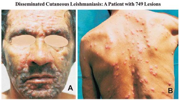Disseminated cutaneous leishmaniasis Multilesional: >10 lesions