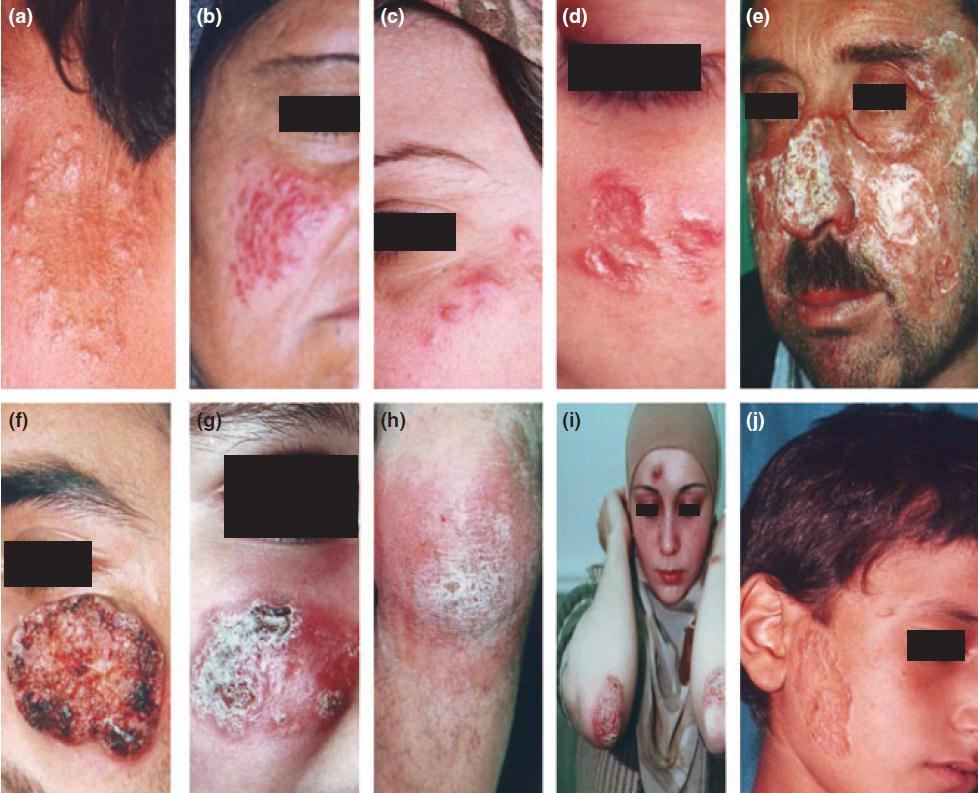 Chronic cutaneous leishmaniasis, a great mimicker with various clinical presentations: 12 years experience from