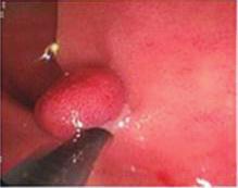 3%) who underwent endoscopic biopsy were confirmed to