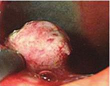 (Bc) Endoscopic submucosal dissection: after submucosal