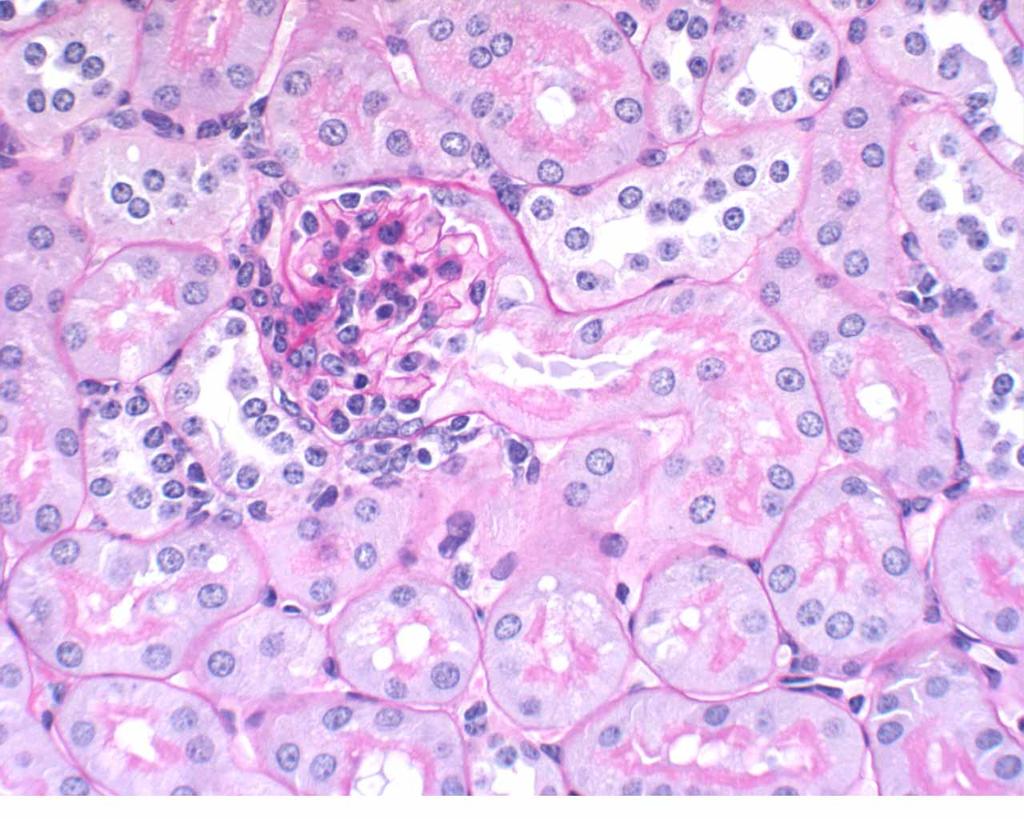 Distal glomerulus Proximal PAS stain (Periodic Acid
