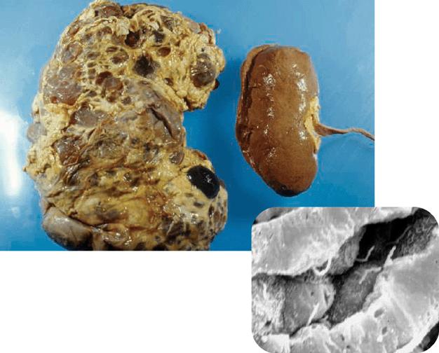 Compared to a normal kidney (right), those from people with polycystic kidney disease (left) are enlarged and ravaged with
