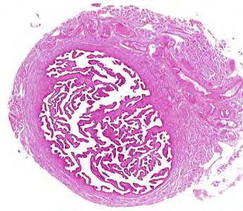 Abnormal human fallopian tube which are both