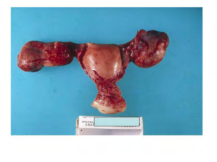 Normal human fallopian tube with highly folded