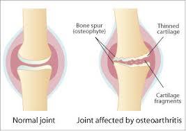 stiffness, swelling Osteoarthritis Degenerative joint disease Most common