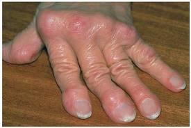 Rheumatoid Arthritis Inflammatory condition