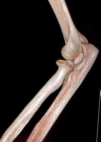It was determined that there was enough bone at the subtalar joint (orange line) and the cacaneous was recontructed successfully; 2D radiographs did