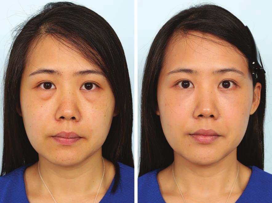 Volume 140, Number 2 Lower Eyelid Blepharoplasty Fig. 6. A 31-year-old woman presented with eye bags and a prominent tear trough deformity.