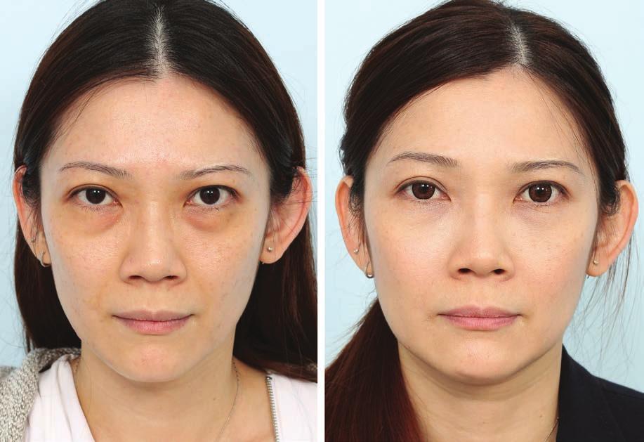 Plastic and Reconstructive Surgery August 2017 Fig. 8. A 40-year-old woman presented with a very tired appearance.