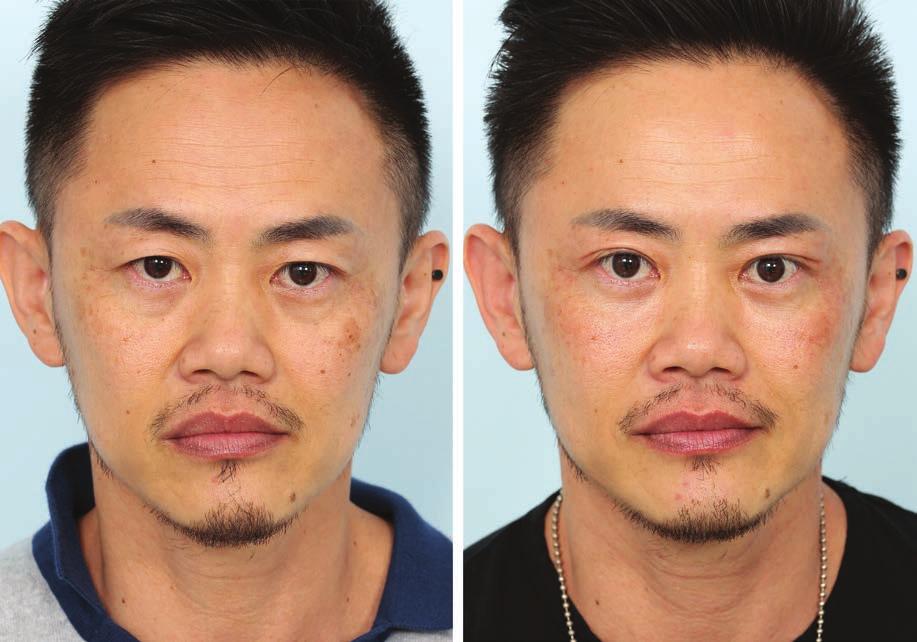 She is shown here preoperatively and 1 year postoperatively. Fig. 9. A 44-year-old man with periorbital aging. He underwent the extended transconjunctival lower blepharoplasty.