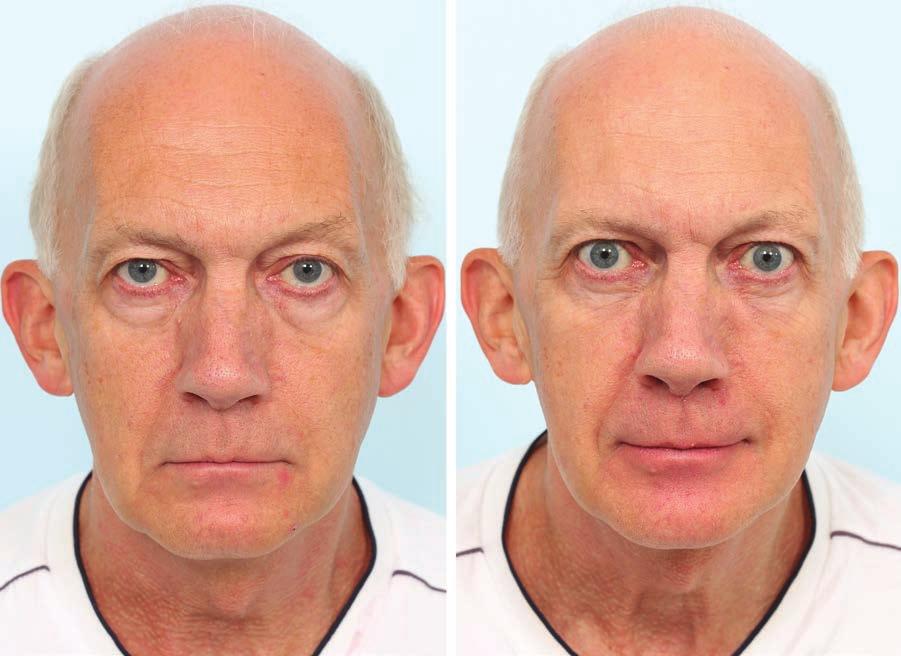 Volume 140, Number 2 Lower Eyelid Blepharoplasty Fig. 10. A 61-year-old man presented with eye bags. He had significant skin laxity and photoaging.