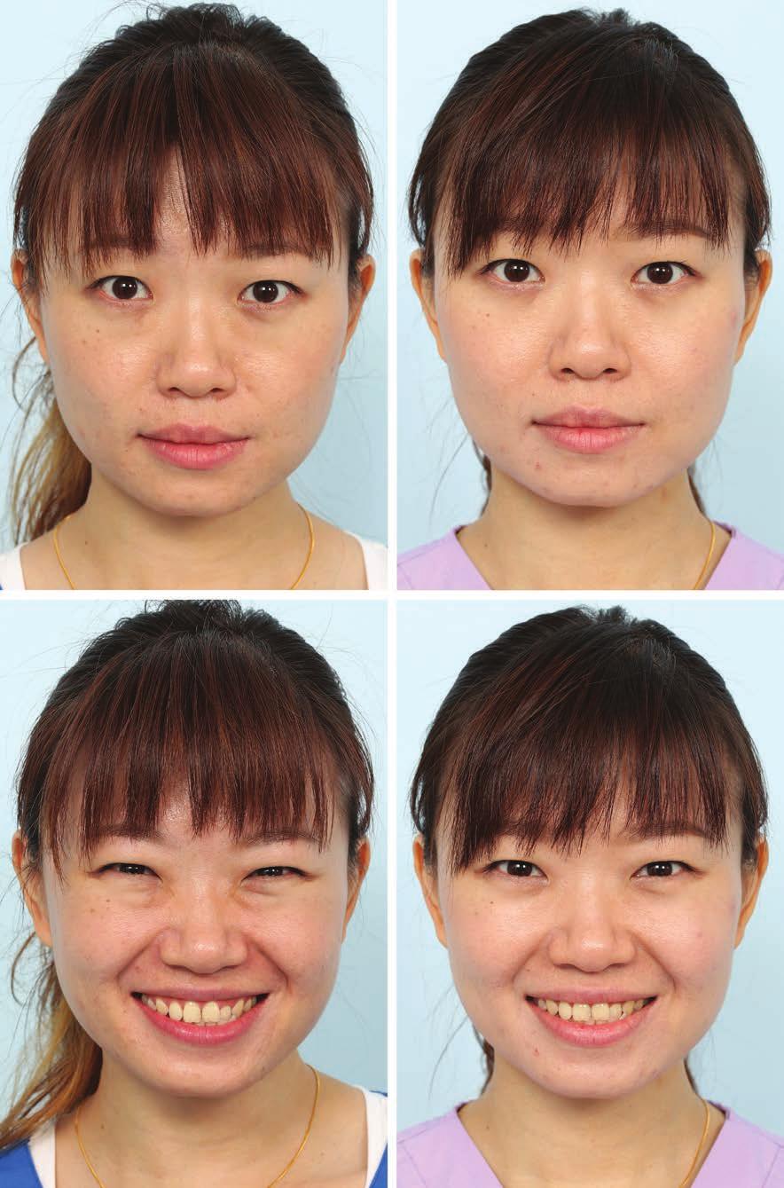 Plastic and Reconstructive Surgery August 2017 Fig. 11. (Above) Before-and-after photographs at rest. A 33-year-old woman presented primarily with the concern of prominent eye bags when smiling.