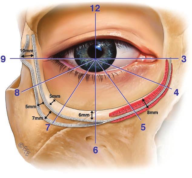 Volume 140, Number 2 Lower Eyelid Blepharoplasty changes occurring primarily over the medial midcheek, with eye bags, a prominent tear trough deformity, and maxillary retrusion.