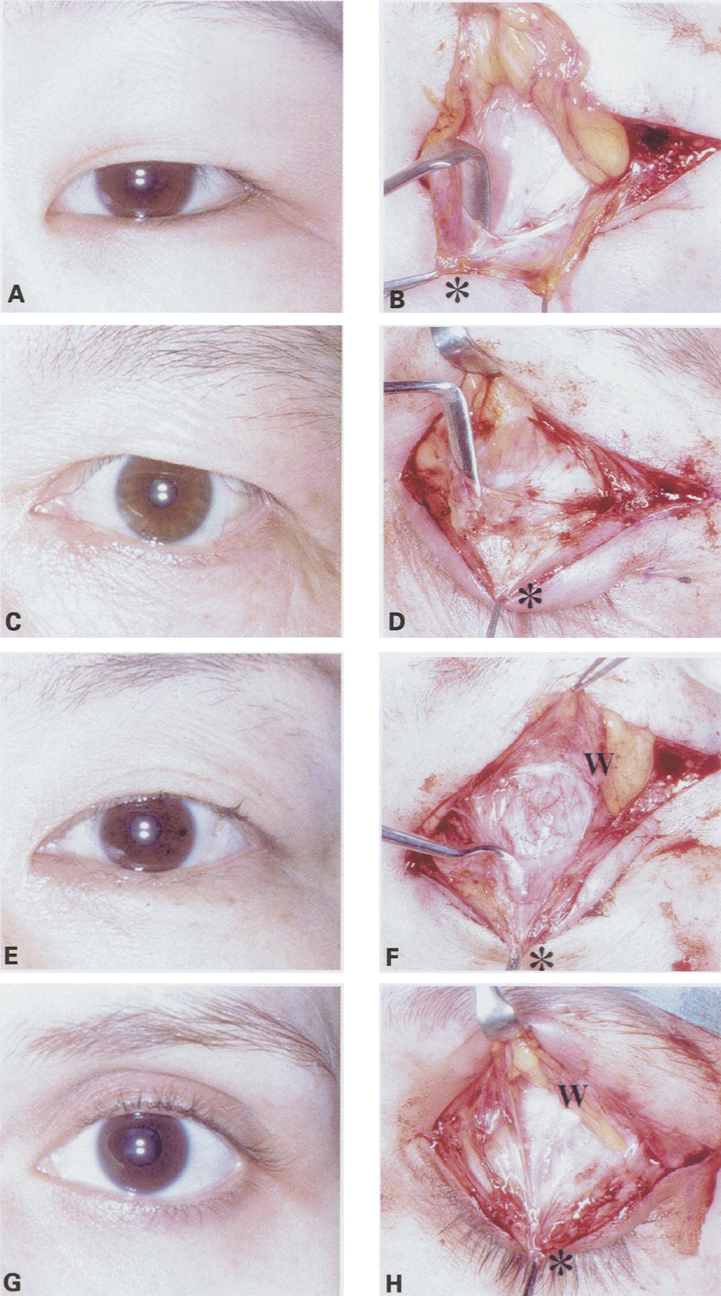(A, B) A puffy eyelid with a narrow palpebral fissure has a robust ligamentous structure. The asterisk (*) indicates the orbital septum, which is horizontally incised and turned down.