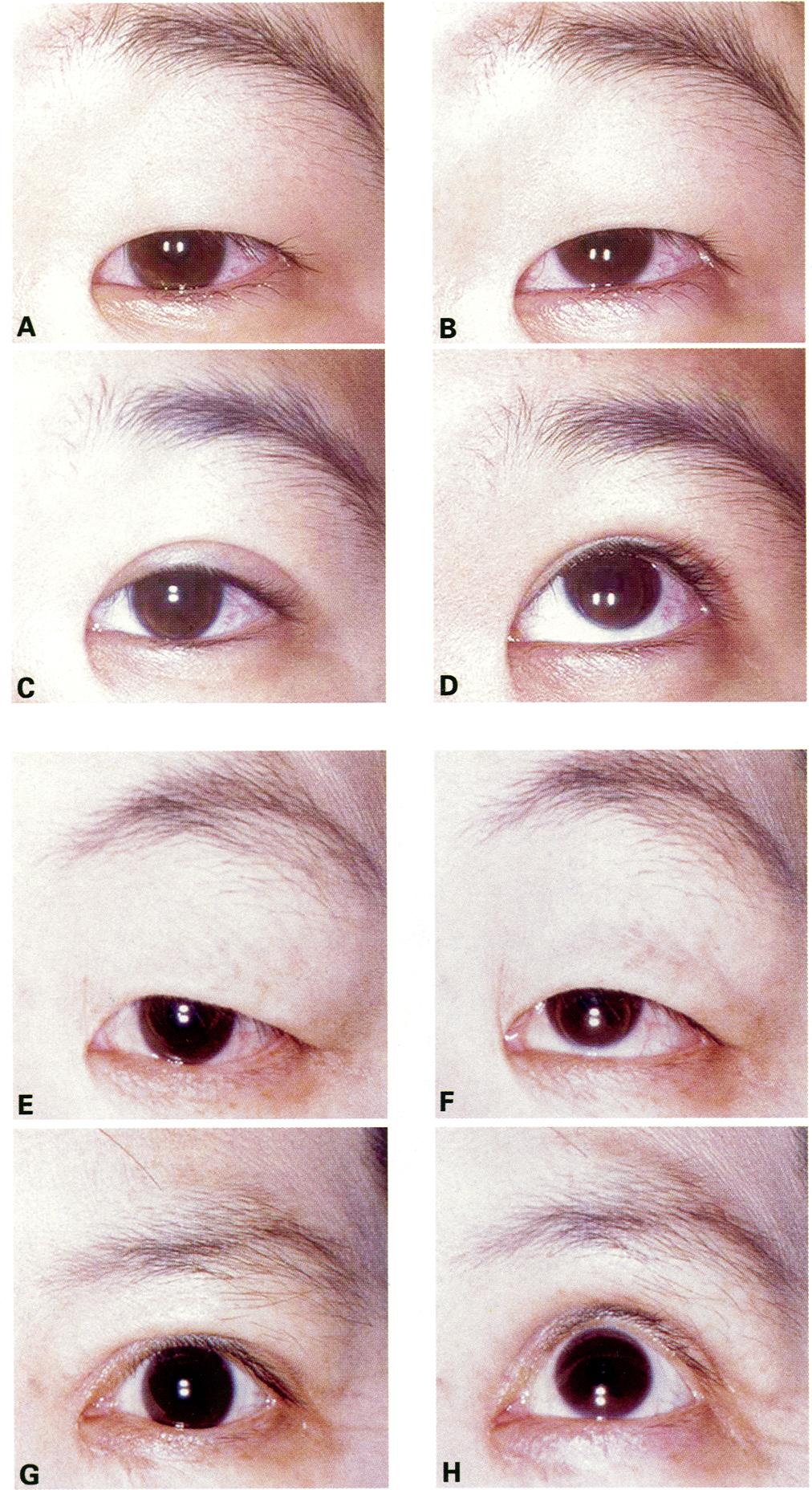 Retraction of the upper eyelid during upward gazing is restricted compared with that during primary gazing.