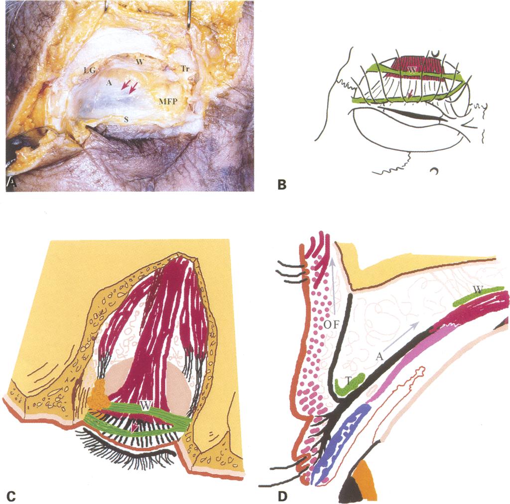 The arrows indicate the lower-positioned transverse ligament (Tr: trochlea, W: Whitnall's ligament, LG: lacrimal gland, A: levator aponeurosis, MFP: medial fat pad of the preaponeurotic space, S:
