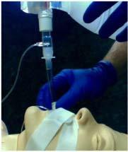 3 Using the distal end of the Filterline, connect the tapered end directly on top of the advanced airway, and the other end to the BVM. (Photo 5) Photo 5 7.