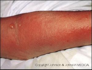 Infective Phlebitis The main infective complication of