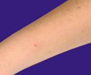 Phlebitis Scoring Scale Visual Phlebitis Score 0 No Symptoms Observe Cannula 1 Erythema at insertion site, with or without pain Observe Cannula 2 All the above plus oedema Resite Cannula 3