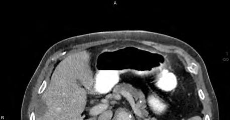TwinBeam Dual Energy* in Oncology showing a hypodense lesion in the liver and the right