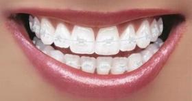 Like invisible braces (Invisalign), ceramic braces can be also a better option for patients who want to maintain a professional image at work or at school while their teeth are being corrected.