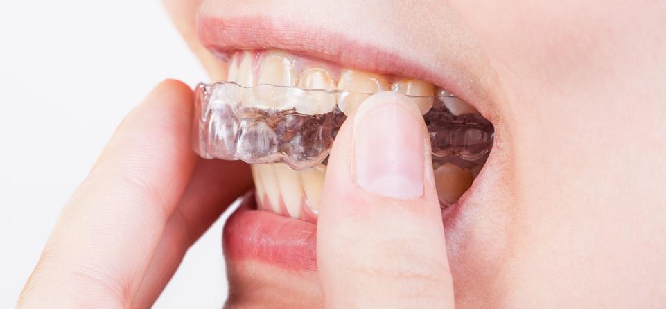 Small white resin bumps, or attachments, will be afixed to some teeth, to help the aligners grip properly and shift your teeth into position.