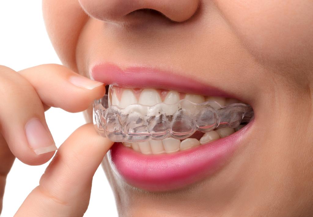 They are the only truly invisible treatment option, so if you re looking for a discreet treatment then lingual braces are definitely worth considering.