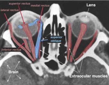 Muscle Insertions Extraocular Muscles Brain Extraocular Muscles LR6, SO4, all the rest are 3 Superior Oblique CN IV Inferior Rectus CN III Medial rectus Inferior Oblique, CN III Lens Medial Rectus CN