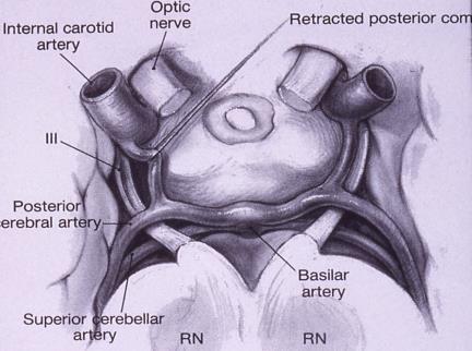 Oblique (reduced excylotorsion) 3 rd Nerve Palsy- Left Eye OS municating artery 3 rd Nerve Palsy Effects