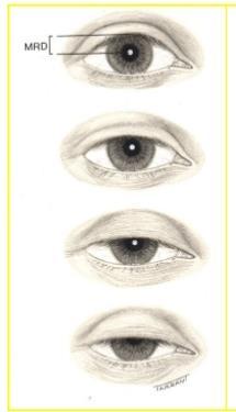 Ptosis Measurements Eyelid Assessments Distance between