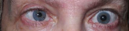 in dark Ptosis in affected eye Anhydrosis (no sweating