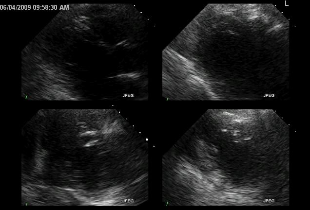 Baseline Stress Clinical Case What do we do now? Can t do nuclear today. Can do cath, but should we? CTA? Admit? Reassure? Consider contrast stress echo.