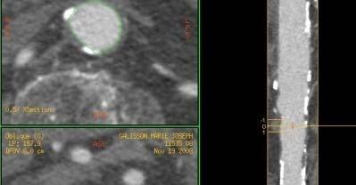 Echocardiography Angio Aortic valve anatomy,